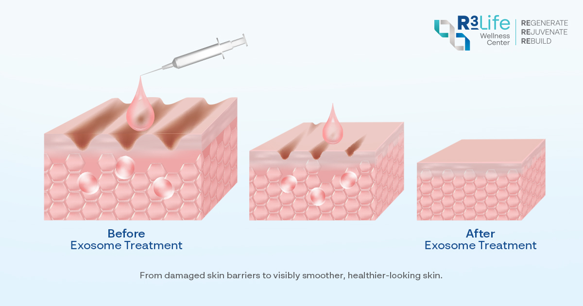 exosome therapy improving collagen and elastin production in aging skin