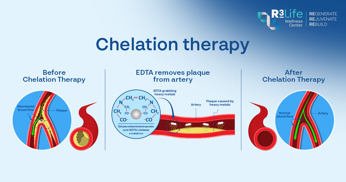 กระบวนการ Chelation Therapy ช่วยขับโลหะหนักออกจากร่างกาย