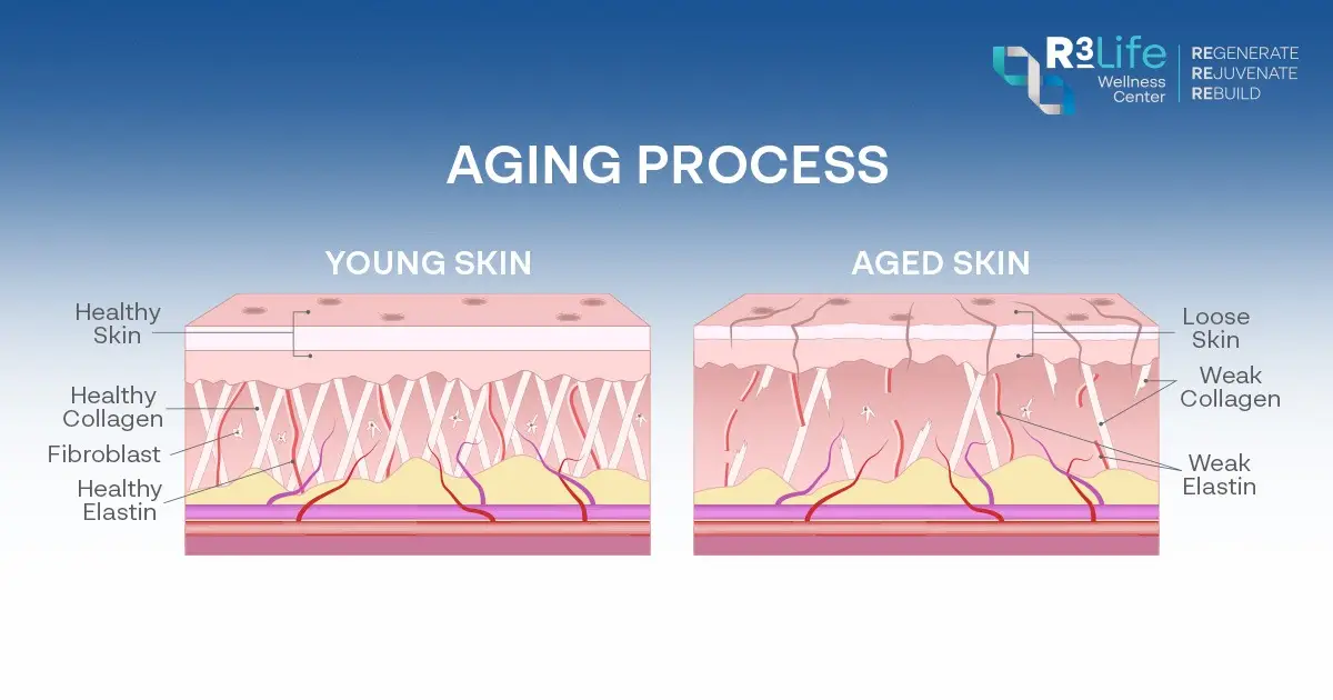 แผนภาพการเสื่อมของผิว คอลลาเจนลดลงจาก inflammaging และ glycation