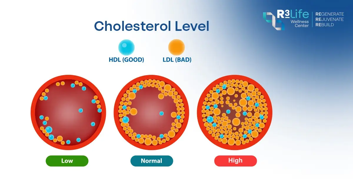 Medical illustration showing LDL cholesterol buildup inside arteries and its impact on cardiovascular health.