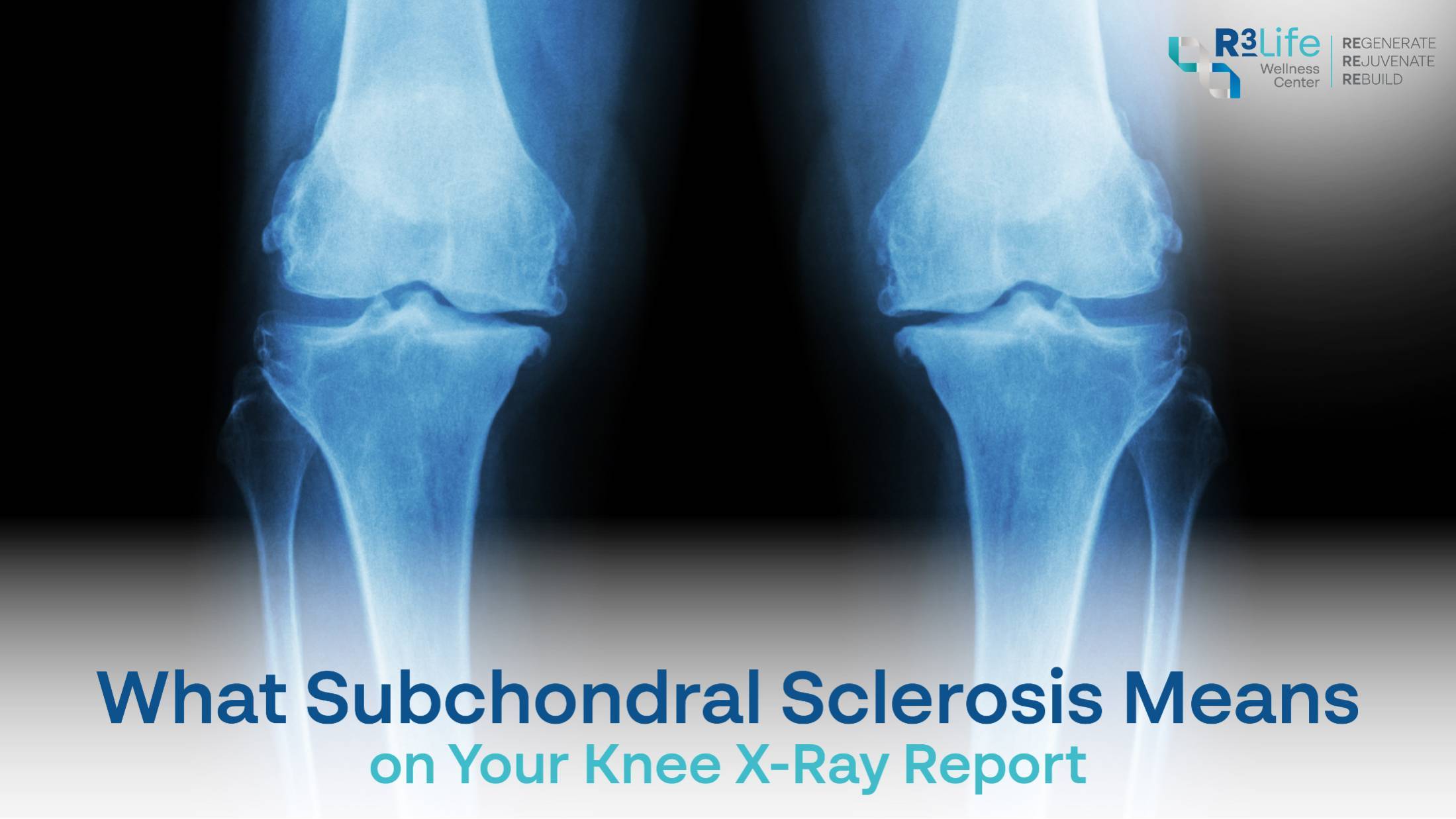 What Subchondral Sclerosis Means on Your Knee X-Ray Report  1