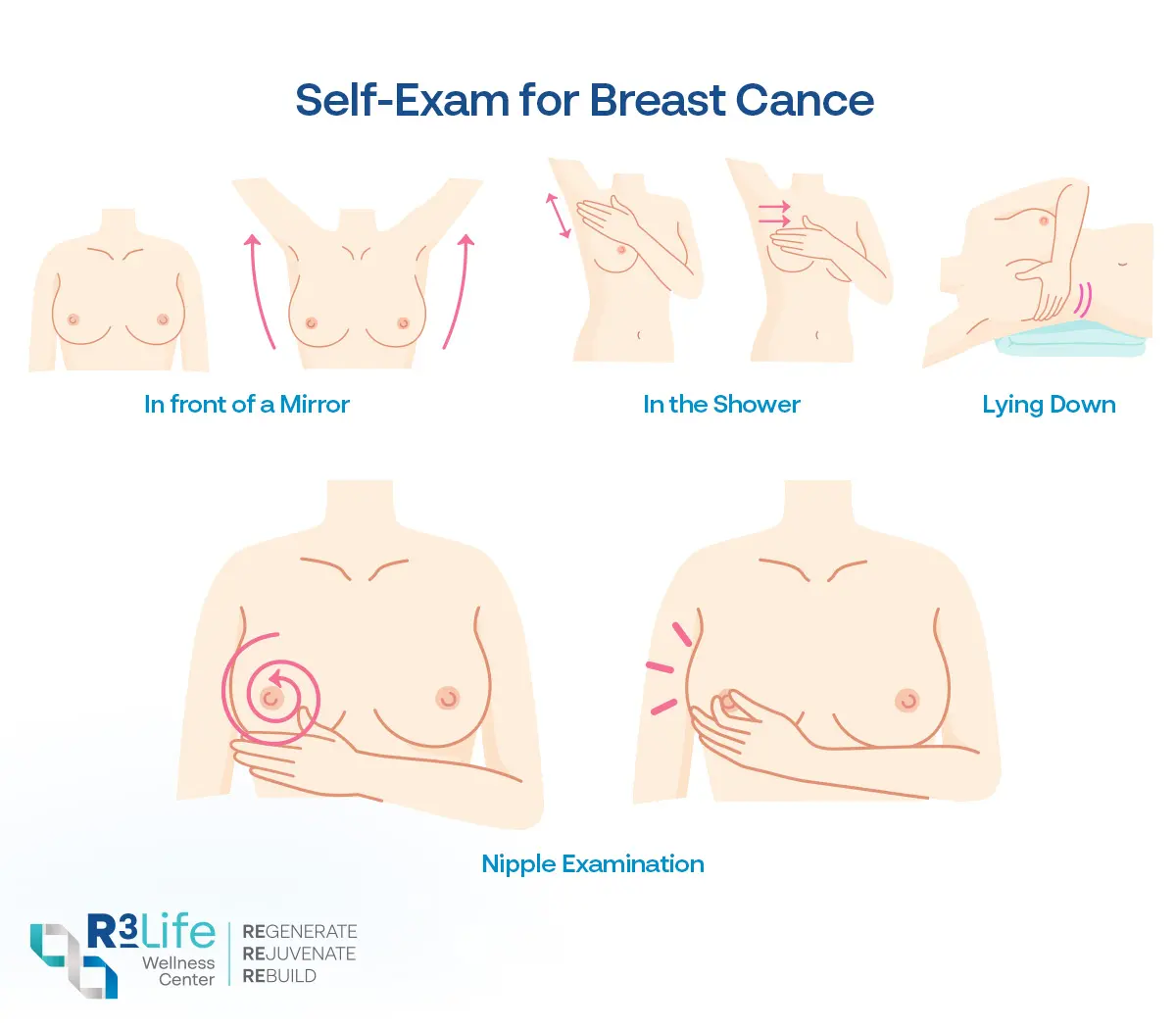 5 Simple Steps to Check for Breast Cancer