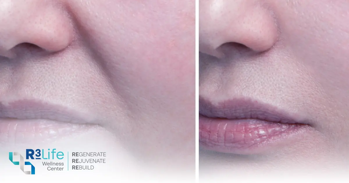 Who is Suitable for Facial Rejuvenation