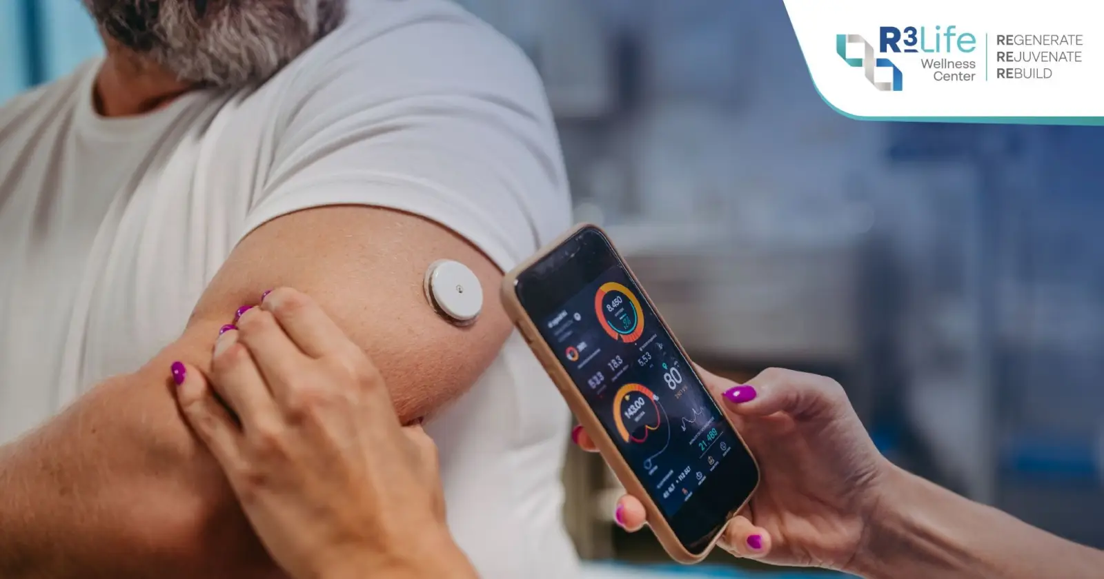 Continuous glucose monitor used to track blood sugar in type 2 diabetes